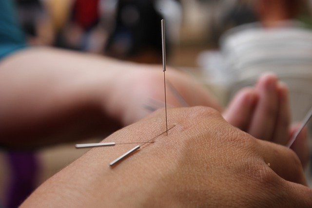 Learn Everything There Is To Know About Acupuncture